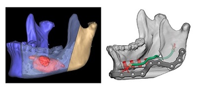 Example of a virtual planning case with the proposed reconstruction of the mandible with a fibula free flap, nerve allograft and immediate dental implants (source: 3d Systems/Stryker)