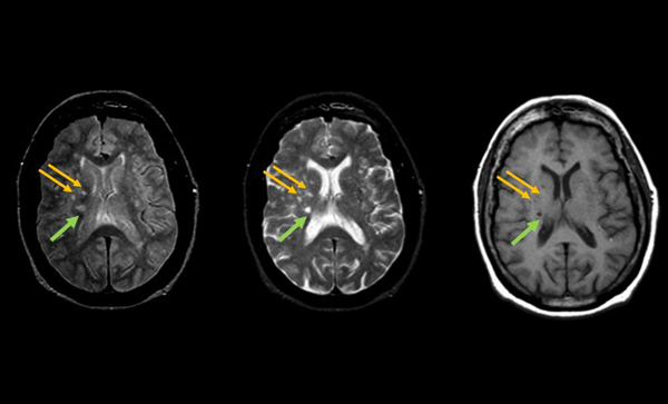 Typically disregarded brain lesions may warn of heightened stroke risk
