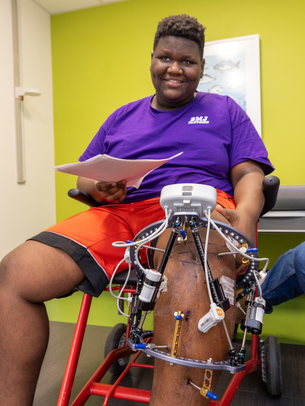 Paul Sykes III smiles after installation of the Maxframe Autostrut, the robotic device that will help his tibia grow straight this spring.